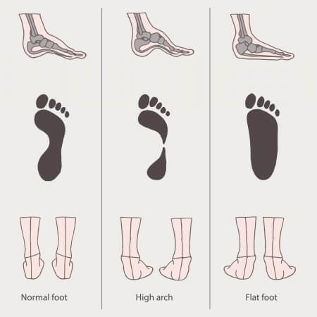 flat-feet-arches-plantar-fasciitis-heel