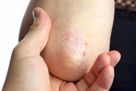 Psoriasis dry cracked elbow