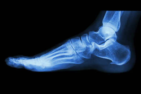 foot-xray-fracture-heel-pain