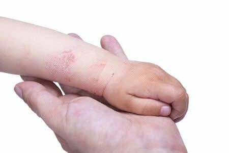 Eczema Symptoms Treatments London Doctors Clinic
