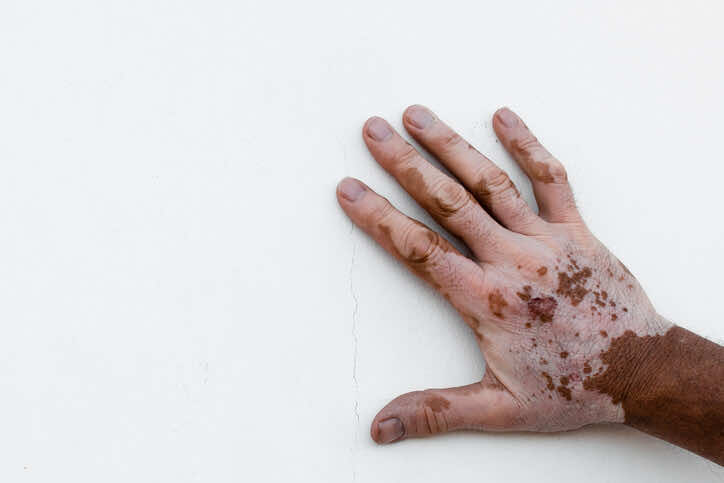 vitiligo-hand