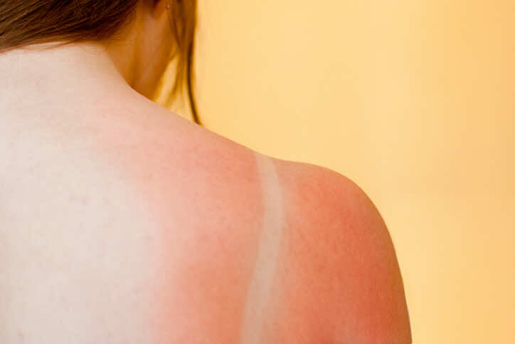 sunburn
