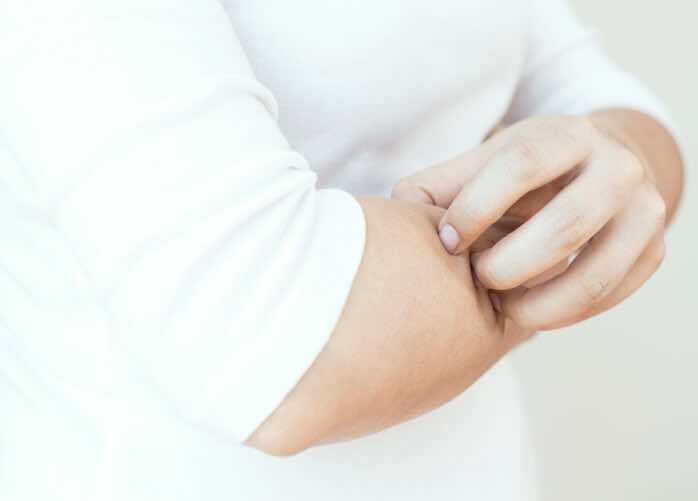 eczema