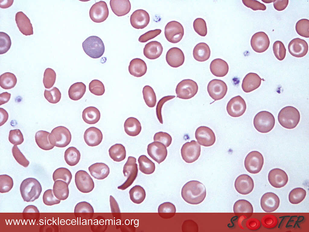 Sickle cell shapes