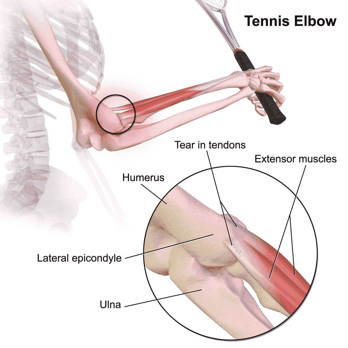 Tennis Elbow Explained